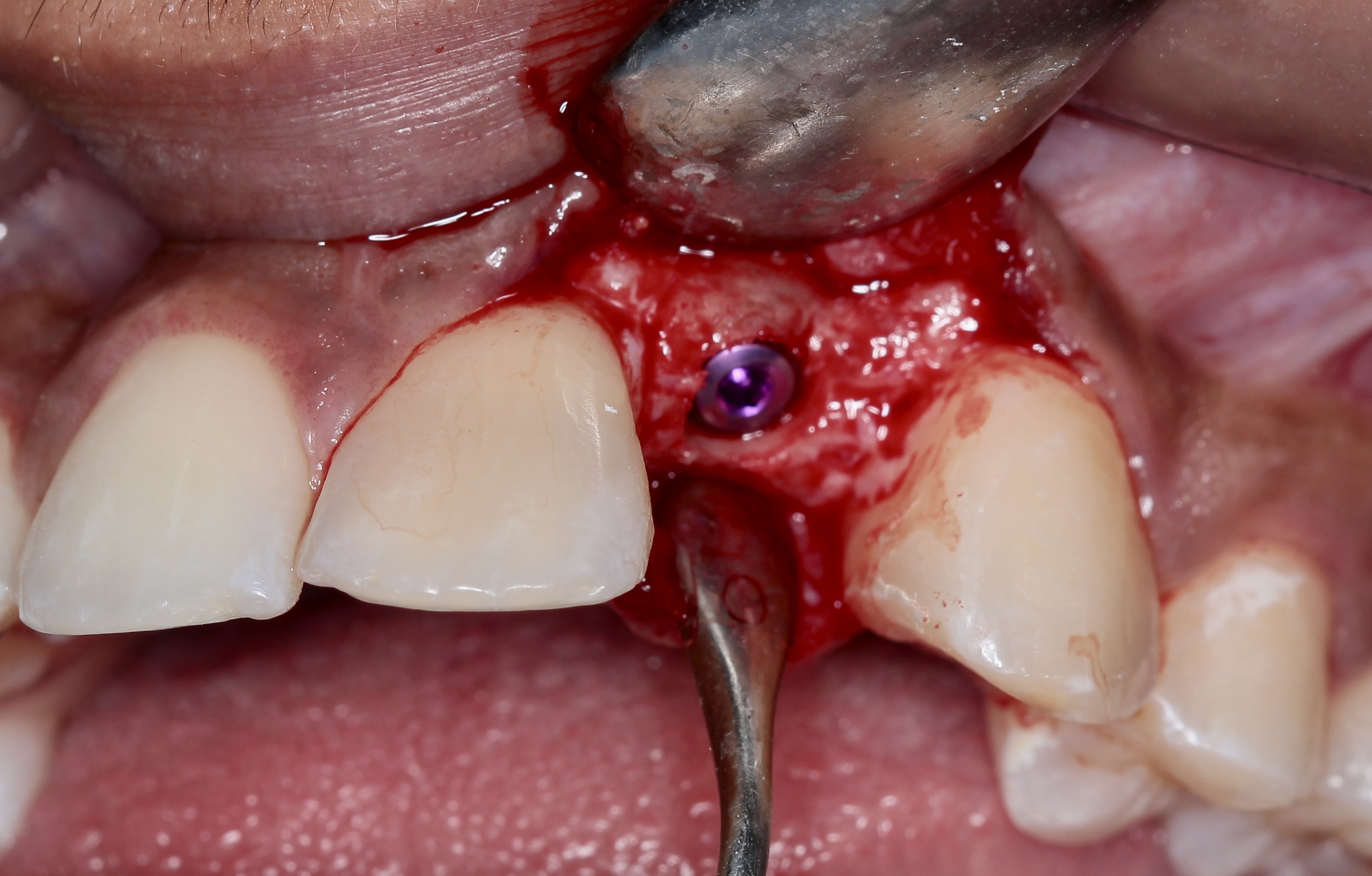 Surgical Bone Augmentation Placement